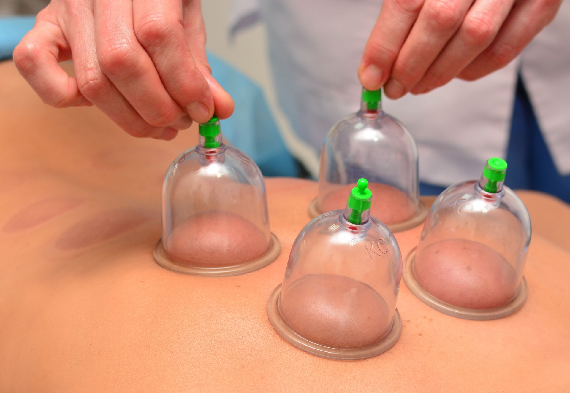 Cupping therapy, woman doctor removes cup from the patient's back